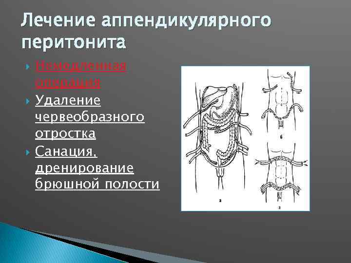 Лечение аппендикулярного перитонита Немедленная операция Удаление червеобразного отростка Санация, дренирование брюшной полости 