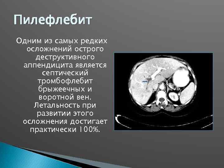 Пилефлебит Одним из самых редких осложнений острого деструктивного аппендицита является септический тромбофлебит брыжеечных и