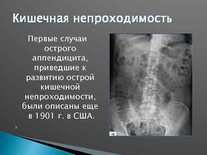 Кишечная непроходимость Первые случаи острого аппендицита, приведшие к развитию острой кишечной непроходимости, были описаны