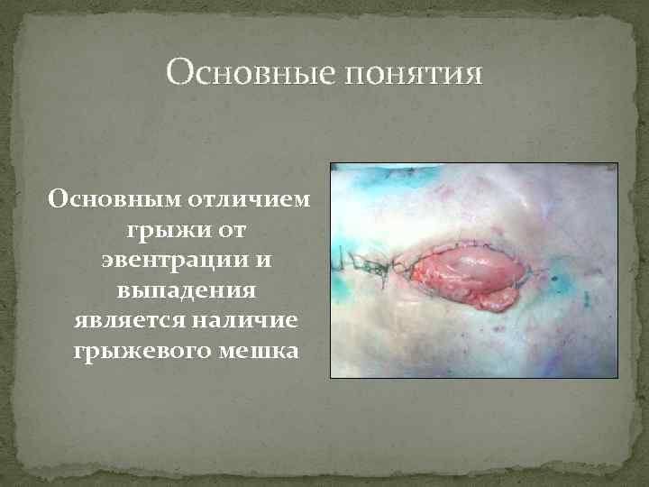 Основные понятия Основным отличием грыжи от эвентрации и выпадения является наличие грыжевого мешка 