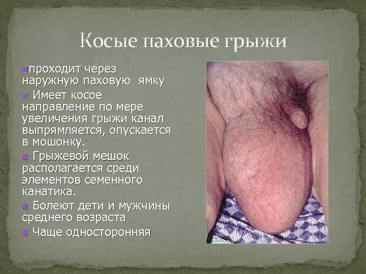 Косые паховые грыжи nпроходит через наружную паховую ямку n Имеет косое направление по мере