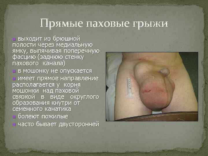 Прямые паховые грыжи выходит из брюшной полости через медиальную ямку, выпячивая поперечную фасцию (заднюю