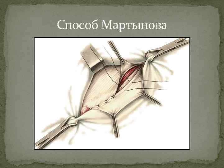 Способ Мартынова 