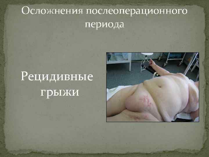 Осложнения послеоперационного периода Рецидивные грыжи 