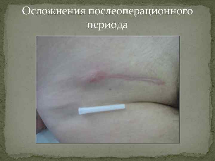 Осложнения послеоперационного периода 