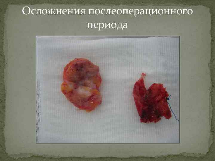 Осложнения послеоперационного периода 