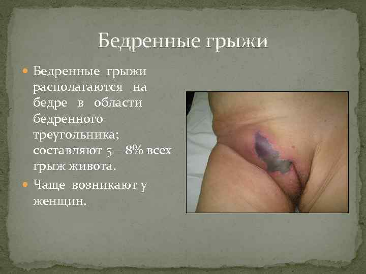 Бедренные грыжи располагаются на бедре в области бедренного треугольника; составляют 5— 8% всех грыж