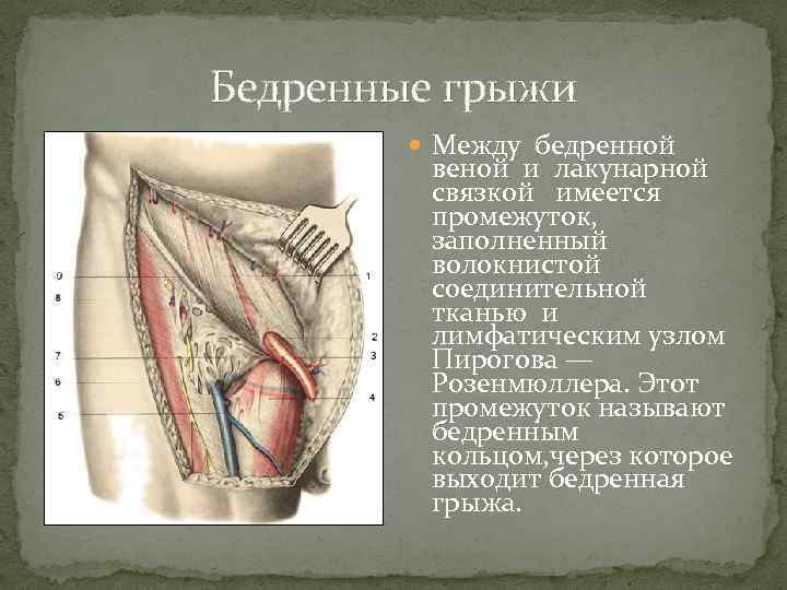 Бедренные грыжи Между бедренной веной и лакунарной связкой имеется промежуток, заполненный волокнистой соединительной тканью