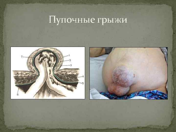 Пупочные грыжи 