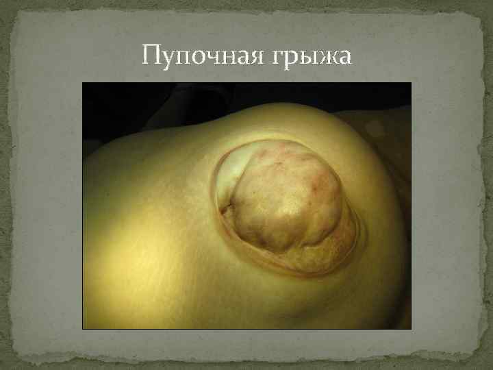 Пупочная грыжа 
