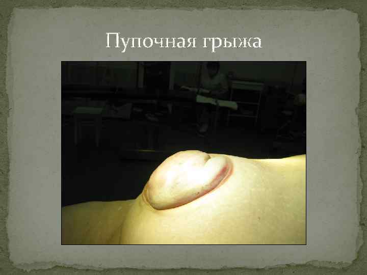 Пупочная грыжа 