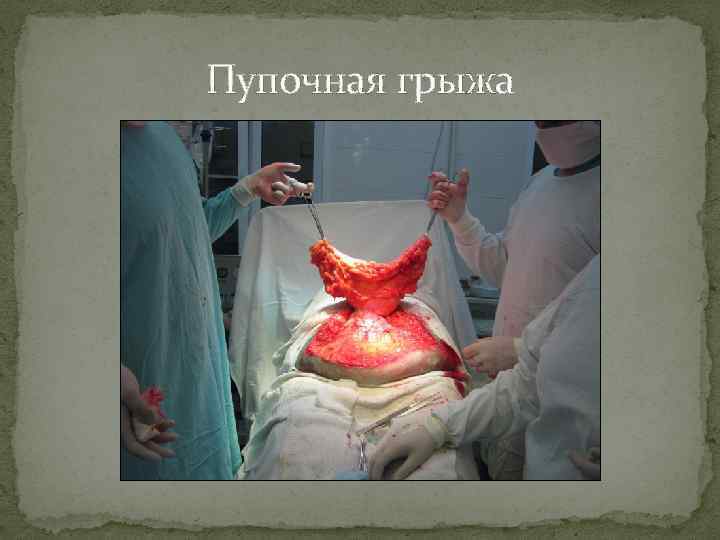 Пупочная грыжа 