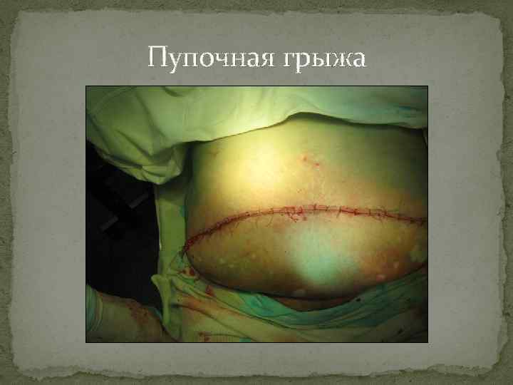 Пупочная грыжа 