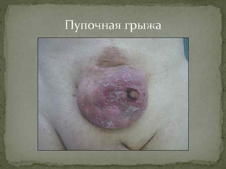 Пупочная грыжа 