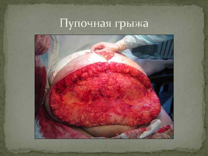 Пупочная грыжа 