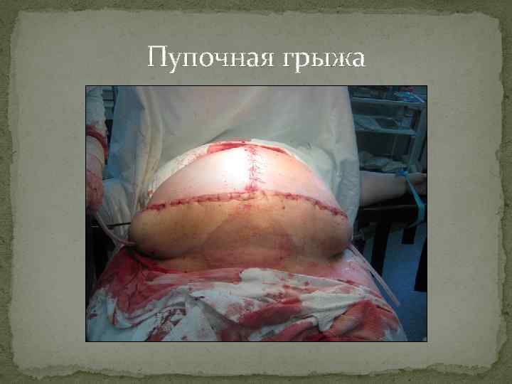 Пупочная грыжа 