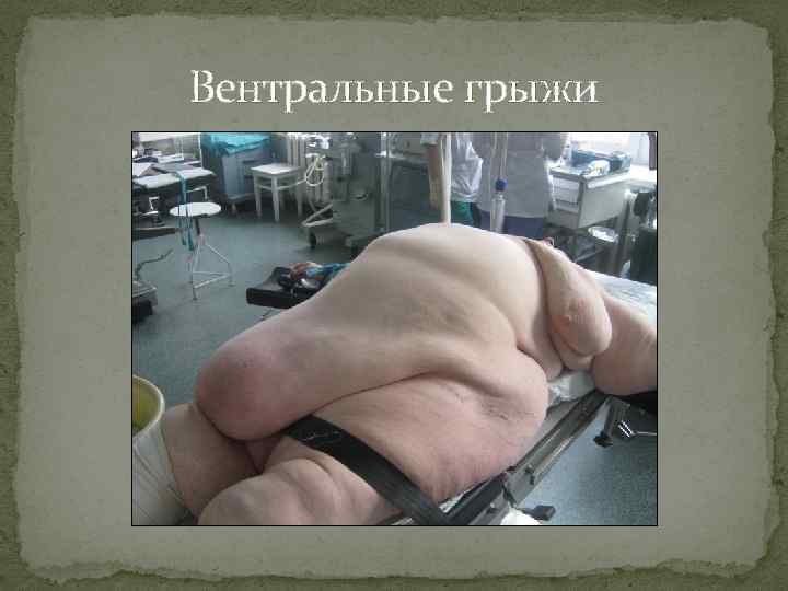 Вентральные грыжи 