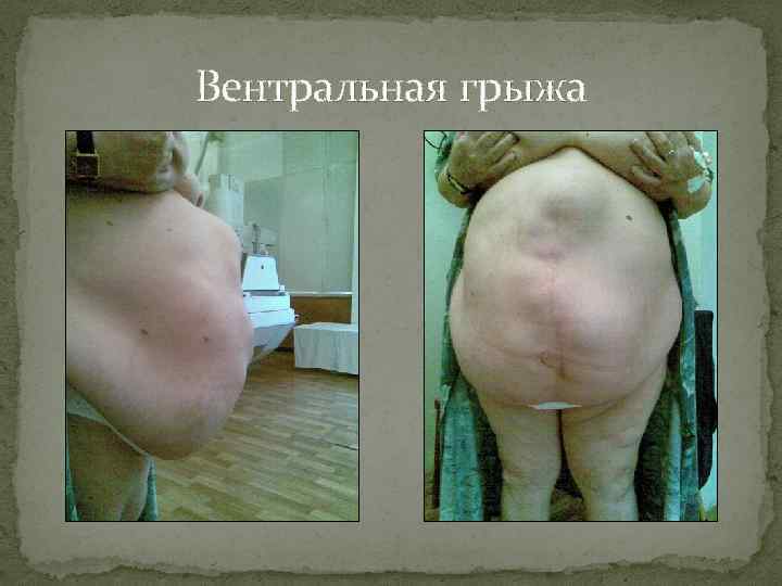 Вентральная грыжа 