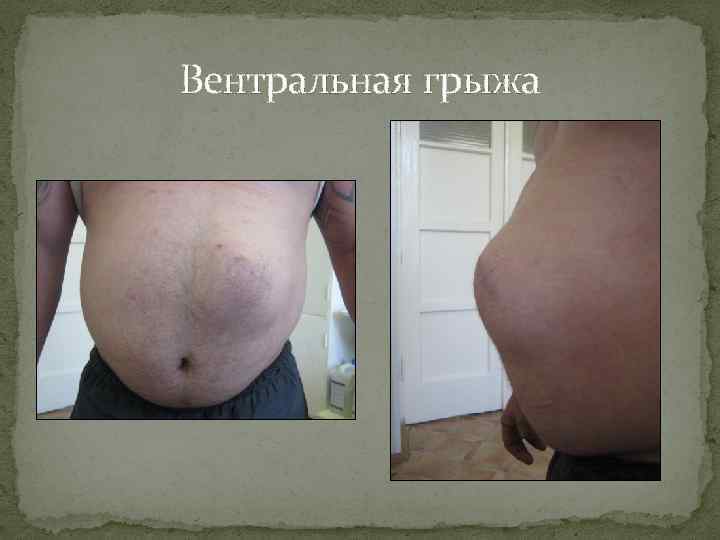 Вентральная грыжа 