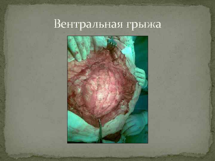 Вентральная грыжа 