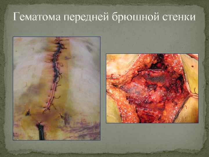 Гематома передней брюшной стенки 
