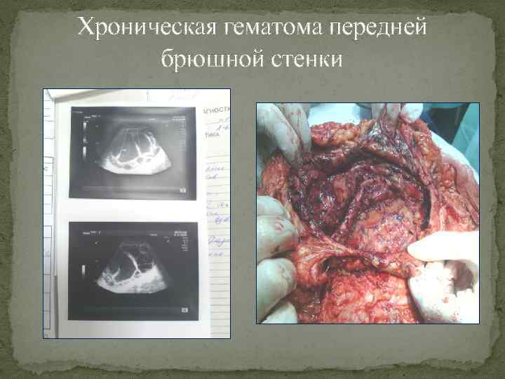 Хроническая гематома передней брюшной стенки 