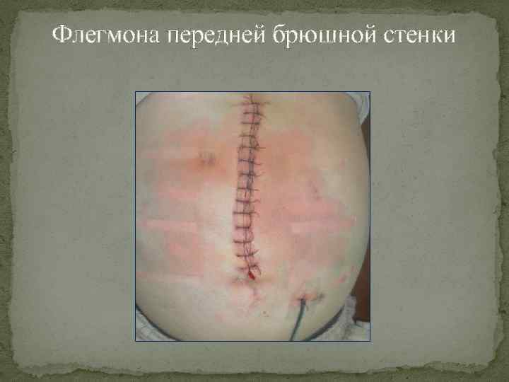 Флегмона передней брюшной стенки 
