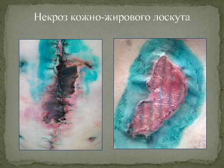 Некроз кожно-жирового лоскута 