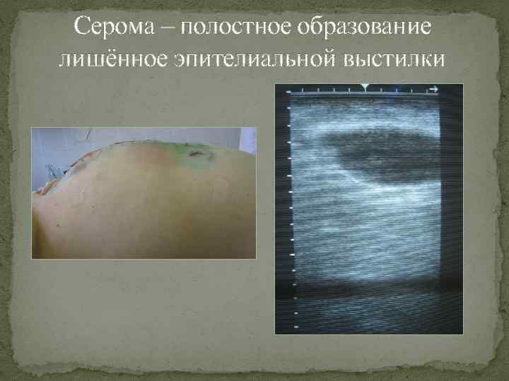 Серома – полостное образование лишённое эпителиальной выстилки 