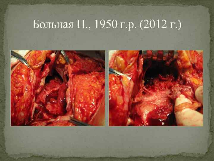 Больная П. , 1950 г. р. (2012 г. ) 