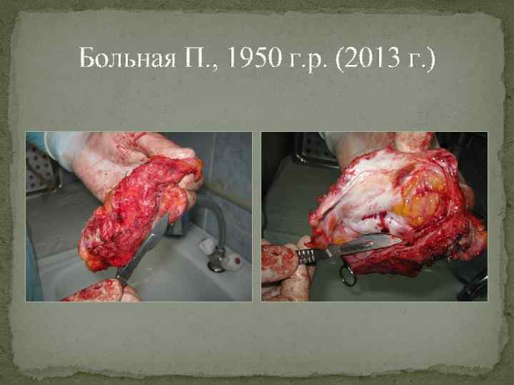 Больная П. , 1950 г. р. (2013 г. ) 