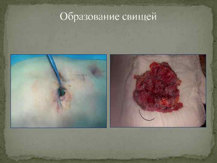Образование свищей 