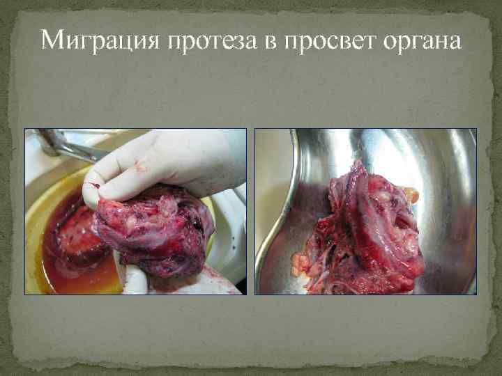 Миграция протеза в просвет органа 