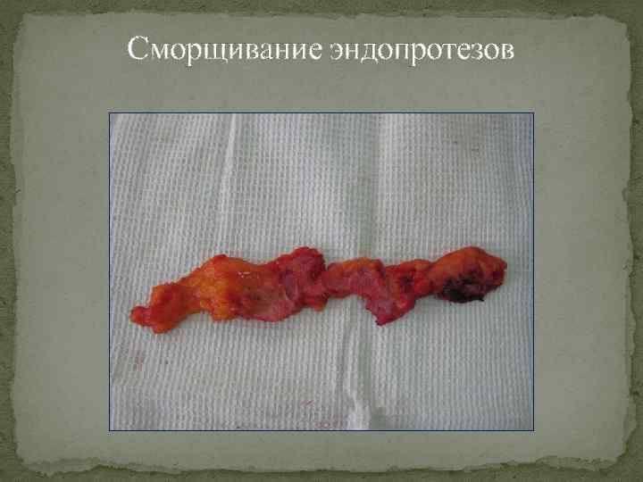 Сморщивание эндопротезов 