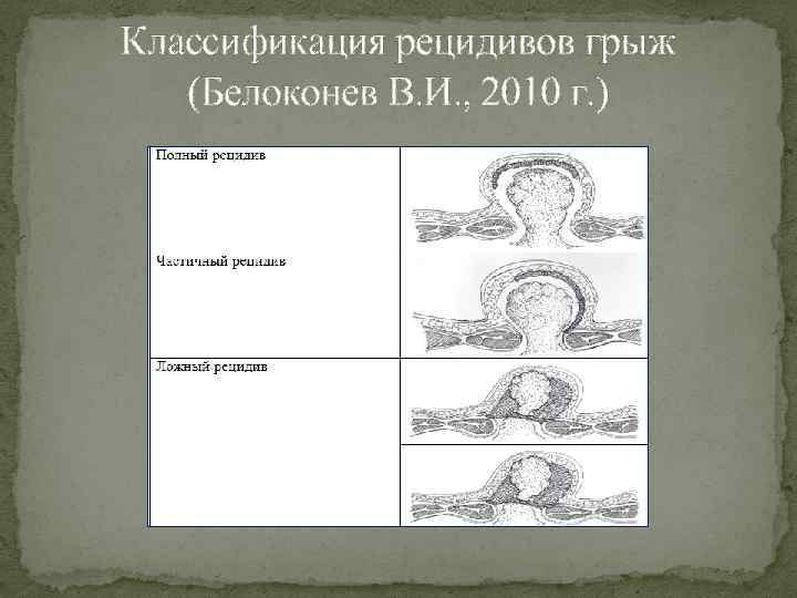 Классификация рецидивов грыж (Белоконев В. И. , 2010 г. ) 