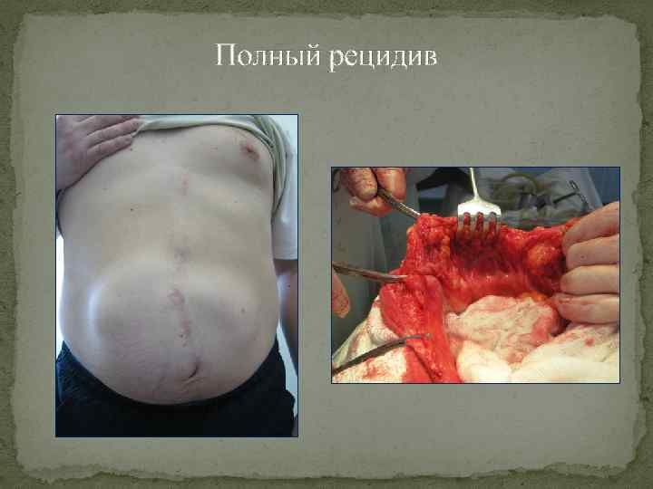 Полный рецидив 