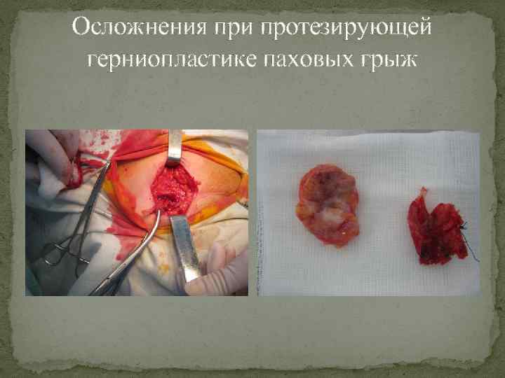 Осложнения при протезирующей герниопластике паховых грыж 