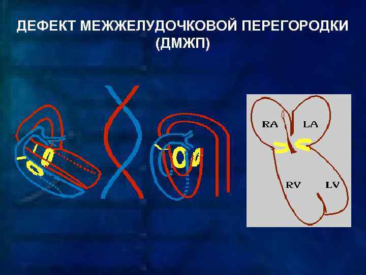 ДЕФЕКТ МЕЖЖЕЛУДОЧКОВОЙ ПЕРЕГОРОДКИ (ДМЖП) 