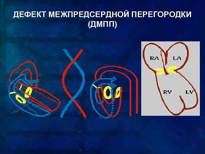 ДЕФЕКТ МЕЖПРЕДСЕРДНОЙ ПЕРЕГОРОДКИ (ДМПП) 