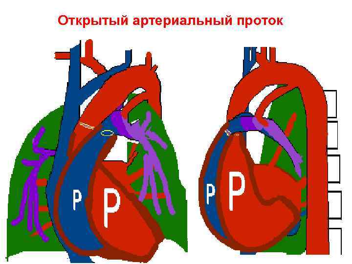 Открытый артериальный проток