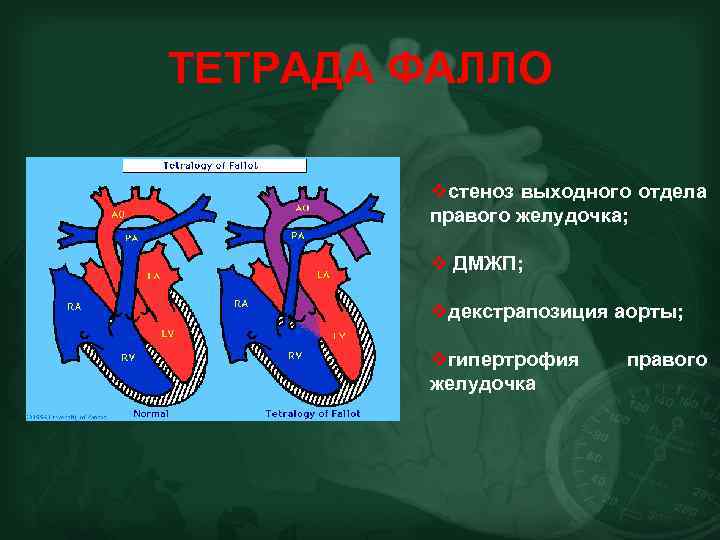 ТЕТРАДА ФАЛЛО vстеноз выходного отдела правого желудочка; v ДМЖП; vдекстрапозиция аорты; vгипертрофия желудочка правого