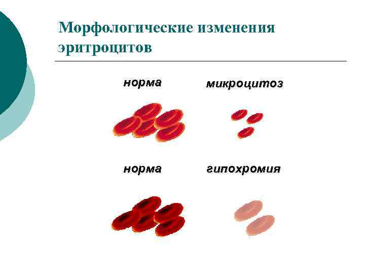 Морфологические изменения. Морфологические изменения эритроцитов. Изменение морфологии эритроцитов. Морфологические изменения эритроцитов при анемиях. Особенности морфологии эритроцитов при анемиях.