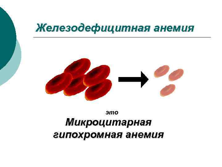 Жда анемия микроцитарная. Гипохромная микроцитарная анемия. Железодефицитная анемия гипохромная микроцитарная. Гипохромный характер анемии.