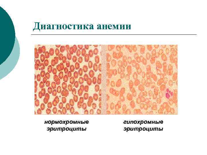 Диагностика анемии нормохромные эритроциты гипохромные эритроциты 