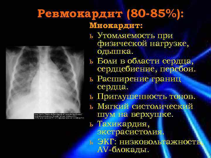 Ревмокардит (80 -85%): Миокардит: ь Утомляемость при физической нагрузке, одышка. ь Боли в области