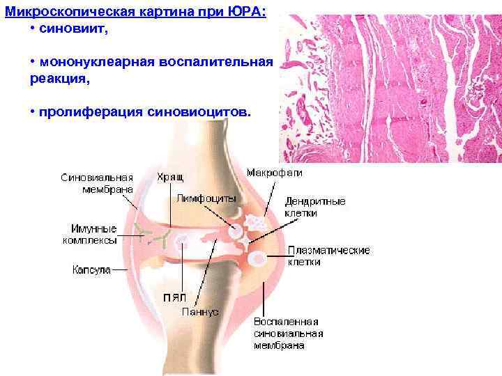 Микроскопическая картина при ЮРА: • синовиит, • мононуклеарная воспалительная реакция, • пролиферация синовиоцитов. 