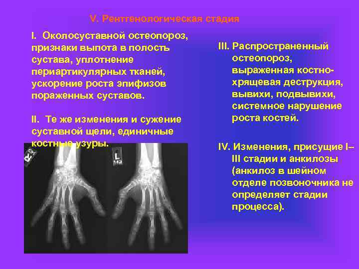 V. Рентгенологическая стадия I. Околосуставной остеопороз, признаки выпота в полость сустава, уплотнение периартикулярных тканей,