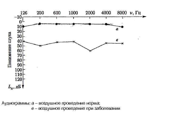 Аудиограммы: a – воздушное проведение норма; в – воздушное проведение при заболевании 