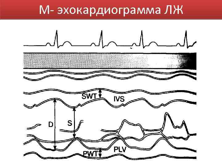 М- эхокардиограмма ЛЖ 