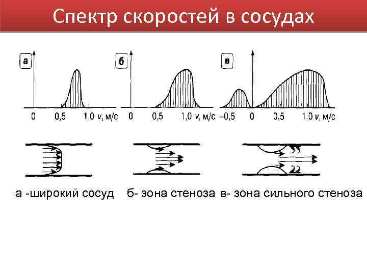 Спектр скоростей в сосудах а -широкий сосуд б- зона стеноза в- зона сильного стеноза